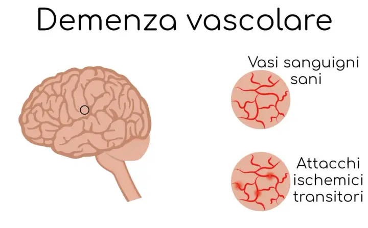 Illustrazione del cervello con un cerchio che indica un'area interessata da vasculopatia cerebrale cronica nell'anziano. Confronto tra vasi sanguigni sani e quelli colpiti da attacchi ischemici transitori.