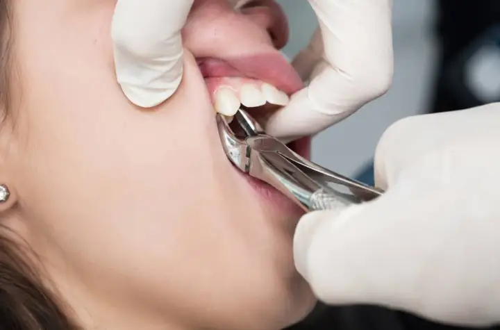 Chirurgiczne usuwanie zęba w trakcie zabiegu. Dentysta w białej rękawiczce używa kleszczy stomatologicznych.