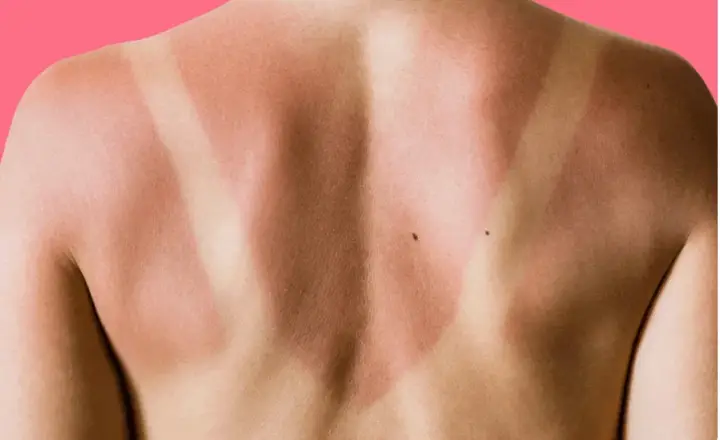 Schiena con evidente abbronzatura a strisce, segno di una giornata al sole con indumenti che hanno lasciato la pelle scoperta in alcune zone.