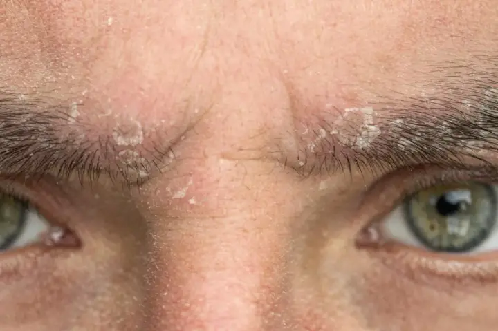 Gros plan sur le visage d'une personne, montrant une peau sèche et squameuse autour des yeux et sur le front. Une pellicule sourcil est visible, indiquant une irritation cutanée.