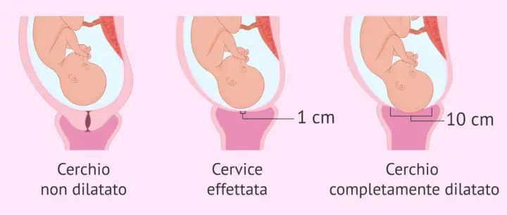 Illustrazione del travaglio: cervice non dilatata, dilatata di 1 cm e completamente dilatata (10 cm). Il cerchiaggio cervicale è una procedura per sostenere una cervice debole.