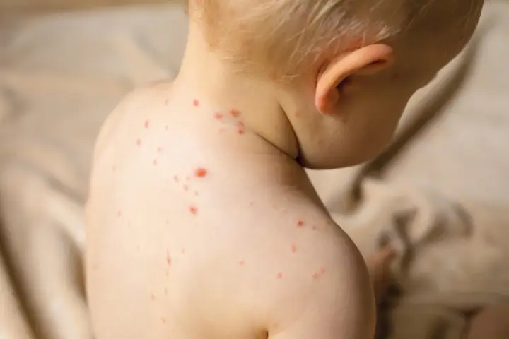 Enfant atteint de varicelle, avec des boutons rouges sur le dos et le cou. Conseils pour aider à comment faire sécher les boutons de varicelle rapidement.