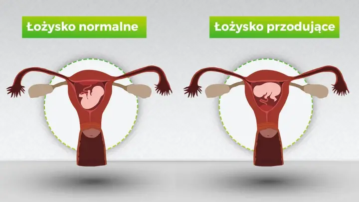 Porównanie: łożysko normalne vs. łożysko przodujące. Na pierwszym obrazku łożysko znajduje się na tylnej ścianie macicy, a na drugim – łożysko na przedniej ścianie.
