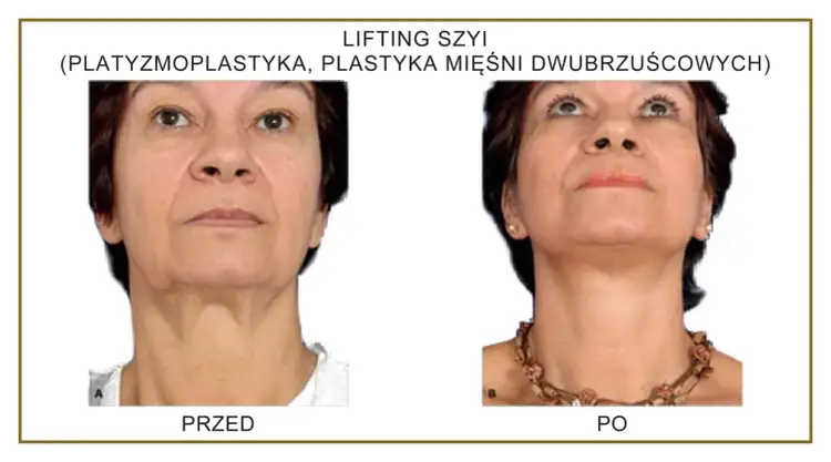 Przed i po zabiegu liftingu szyi. Widoczna poprawa napięcia skóry i konturu.