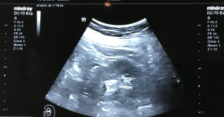 Obraz USG z widocznym zarodkiem, symbolizującym początki rozwoju medycyny prenatalnej, kiedy wynaleziono USG ciąży.