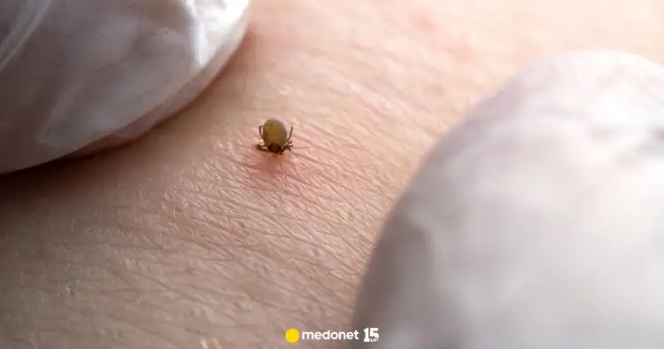 Kleszcz bez pęsety? Usuń go bezpiecznie! Unikaj tych błędów