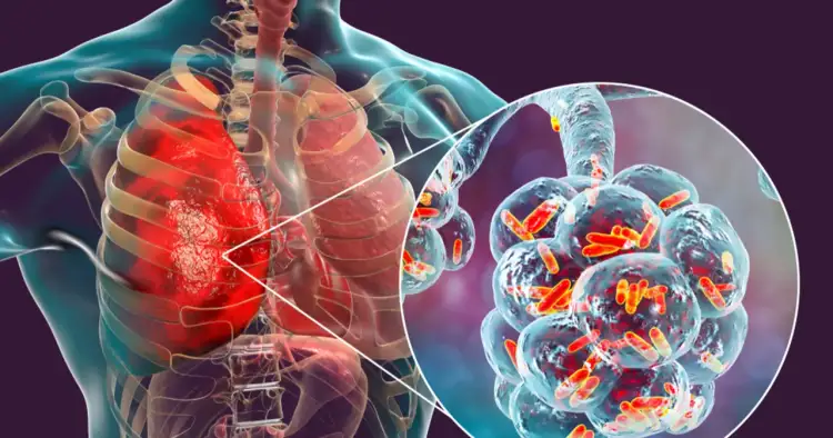 Zapalenie płuc objawy: widok płuc z zaczerwienionym obszarem i powiększony widok pęcherzyków płucnych z bakteriami.