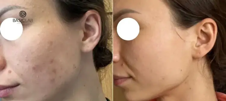 Serum z witaminą C co daje? Odkryj niesamowite efekty dla skóry