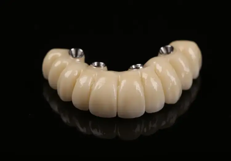 Ile kosztuje implant zęba? Sprawdź ceny i ukryte wydatki