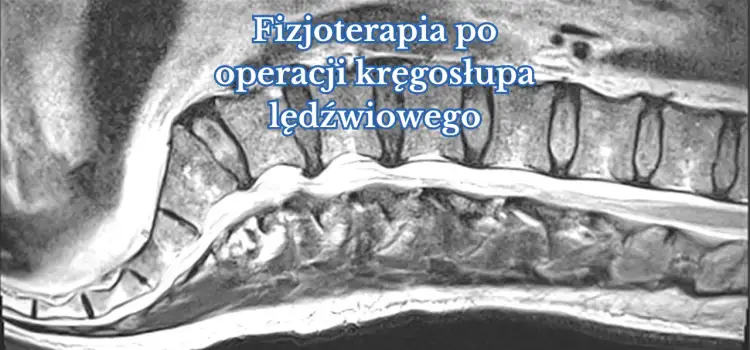Kiedy rehabilitacja po operacji kręgosłupa lędźwiowego? Kluczowe informacje
