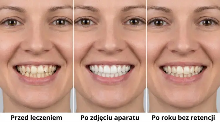 Aparat retencyjny - Jak utrzymać idealny uśmiech po leczeniu?