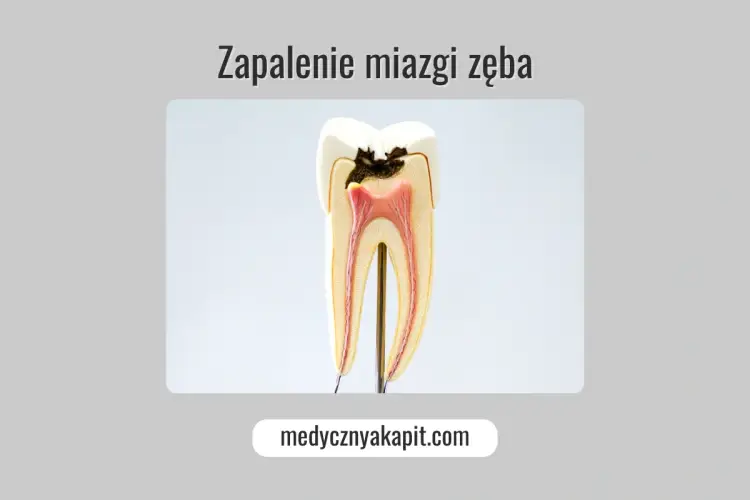 Zapalenie miazgi zęba - objawy, leczenie, ratunek dla zęba