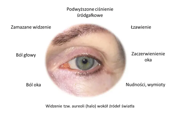 Jaskra - wyleczyć czy kontrolować? Poznaj fakty medyczne