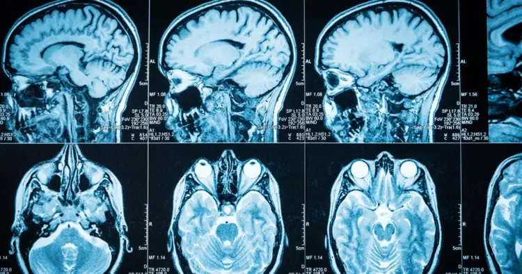 Guz mózgu - objawy, diagnostyka, leczenie. Kiedy ból głowy niepokoi?