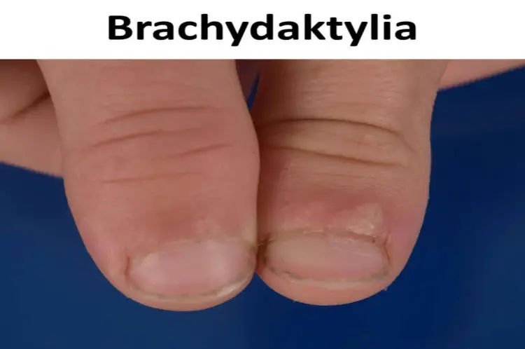Brachydaktylia - Skrócone palce: Cecha czy choroba?