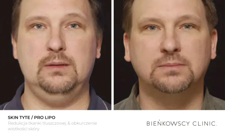 Lipoliza iniekcyjna - Czy to sposób na oporny tłuszcz?