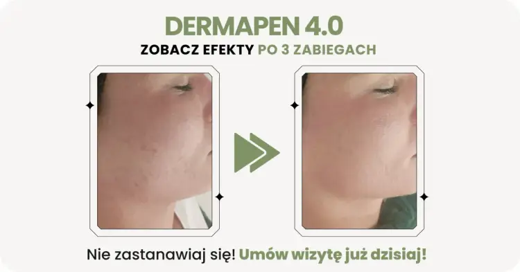 Dermapen po 3 zabiegach - Jakie są efekty i czy to wystarczy?