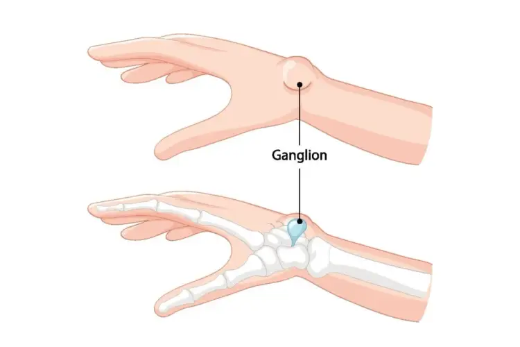 Masz guzek? Ganglion - objawy, leczenie i kiedy iść do ortopedy