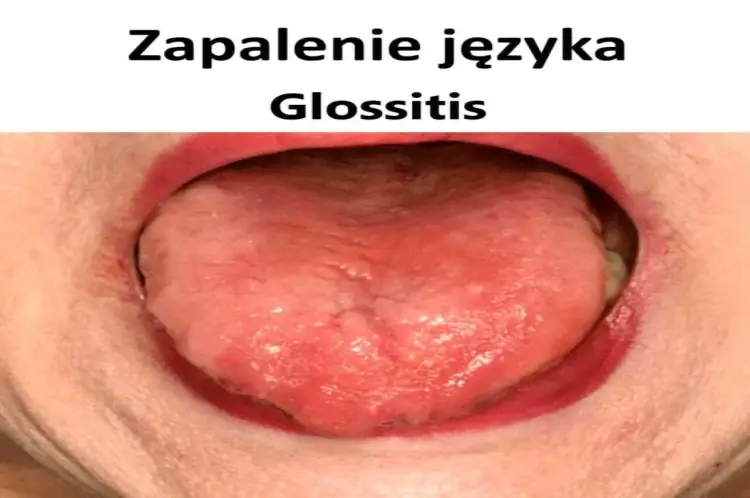 Zapalenie języka - Leki bez recepty i kiedy do lekarza?