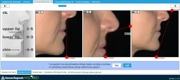 Klikająca szczęka - Kiedy to normalne, a kiedy do dentysty?