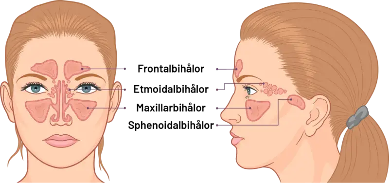 Illustration av bihålorna i ansiktet. Kan visa hur tandproblem kan leda till dental sinuit.