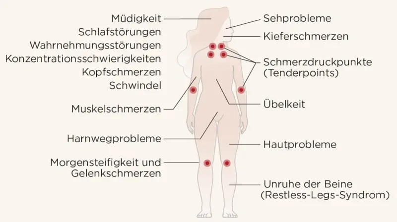 Fibromyalgie symptome: Müdigkeit, Schlafstörungen, Kopfschmerzen, Muskelschmerzen, Übelkeit, Hautprobleme, Sehprobleme, Kiefer- und Gelenkschmerzen, Konzentrationsschwierigkeiten, Schwindel, Harnwegsprobleme, Morgensteifigkeit, Unruhe der Beine.