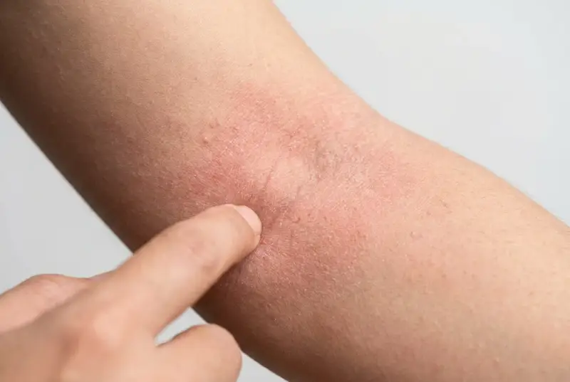 Rote, trockene Haut am Arm, die auf Neurodermitis hindeutet. Eine Hand berührt die betroffene Stelle, um zu zeigen, was hilft gegen Neurodermitis.