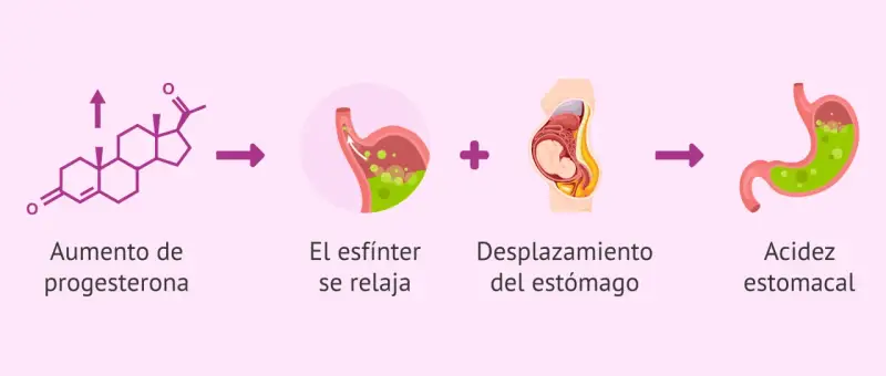 Aumento de progesterona y desplazamiento del estómago en el embarazo causan ardores estomacales.