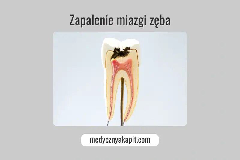 Model zęba ukazujący próchnicę i zapalenie miazgi.