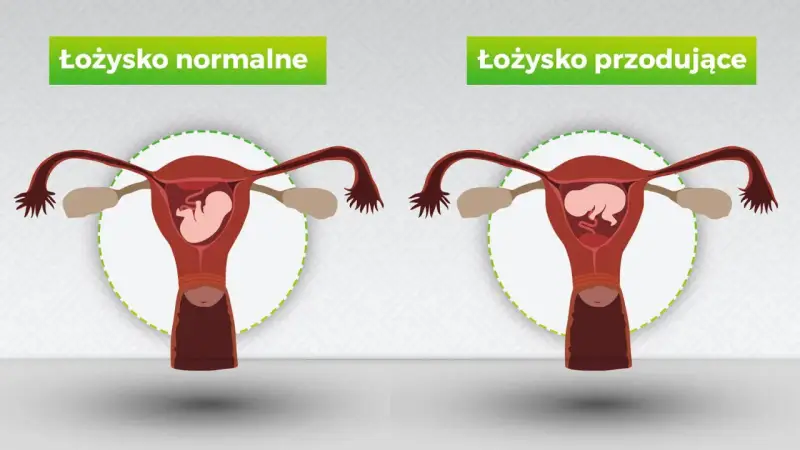 Porównanie: łożysko normalne vs łożysko przodujące. Po prawej stronie widoczna macica z płodem i łożyskiem przodującym, blokującym szyjkę macicy.