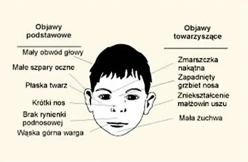 Ilustracja przedstawia twarz dziecka z zaznaczonymi objawami podstawowymi (mały obwód głowy, płaska twarz, krótki nos) i towarzyszącymi (zmarszczka nakątna, zapadnięty grzbiet nosa).