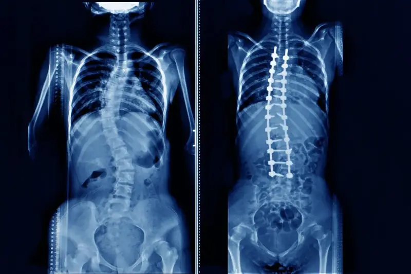 Rentgen klatki piersiowej pokazuje skoliozę kręgosłupa przed i po operacji korekcyjnej z implantami.