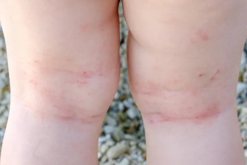 Gambe di bambino con arrossamenti e lievi macchie da sudore sulle ginocchia, forse dovuti al caldo estivo.