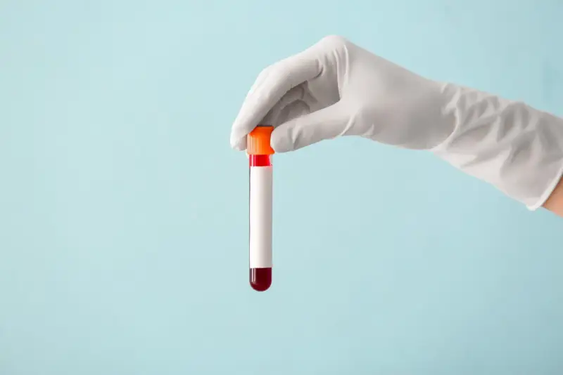 Ręka w białej rękawiczce trzyma probówkę z czerwoną próbką krwi, gotową do analizy, która może wykazać poziom immunoglobuliny.