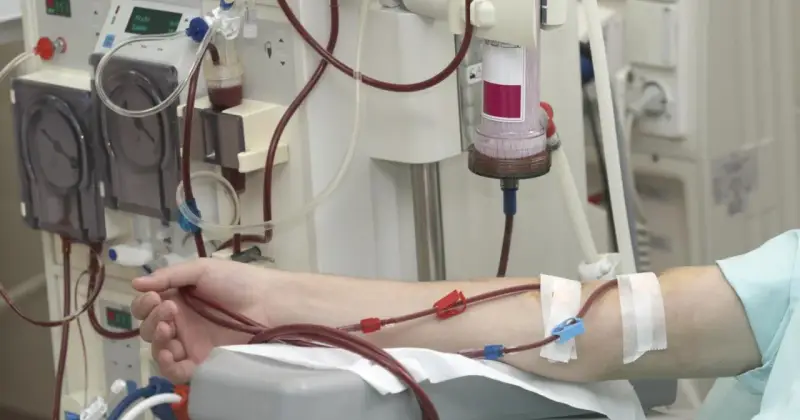 Ramię pacjenta podłączone do aparatury dializacyjnej z widocznymi przewodami i filtrem.
