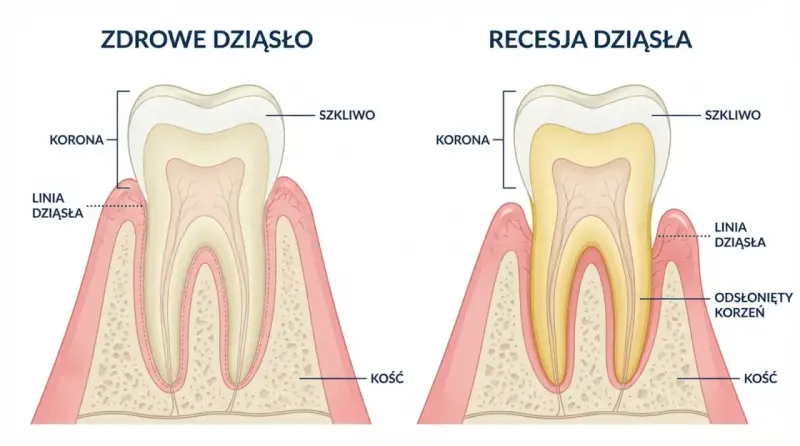 Zdrowe dziąsło vs recesja dziąsła. Recesja powoduje odsłonięcie korzenia i może prowadzić do bólu dziąsła między zębami.