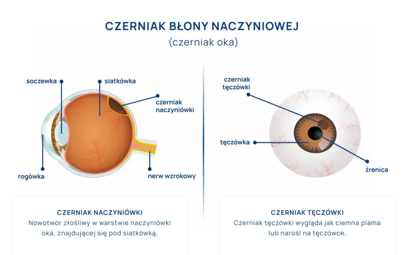 Schemat oka z zaznaczonym czerniakiem błony naczyniowej. Pokazuje czerniaka naczyniówki pod siatkówką i czerniaka tęczówki.