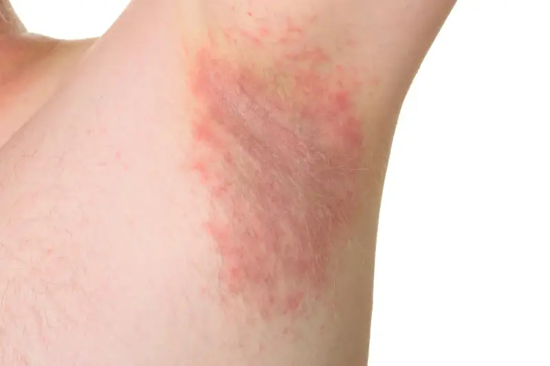 Irritazione cutanea sotto le ascelle, con chiazze rosse e sensazione di prurito sotto le ascelle senza rossore visibile.