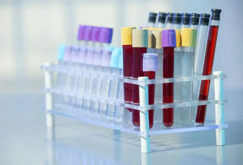 Rurki z krwią w stojaku laboratoryjnym. Czy to badanie CA 125?