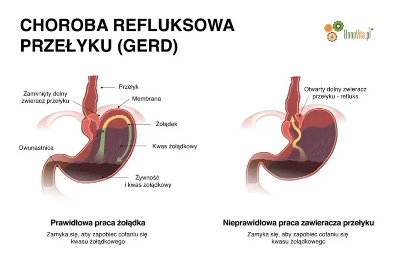 Ilustracja pokazuje prawidłowe i nieprawidłowe działanie żołądka, wyjaśniając objawy refluksu.