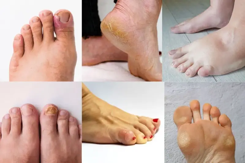 La podologia cos'è? Immagini di piedi con unghie incarnite, talloni screpolati, funghi, calli e gonfiore.
