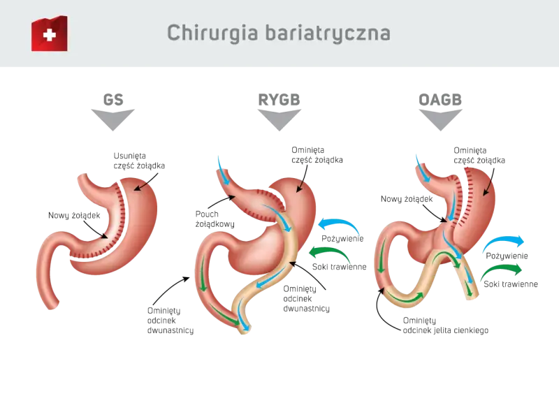 Ilustracja porównuje trzy typy operacji bariatrycznych: GS, RYGB, OAGB. Dowiedz się, ile kosztuje operacja bariatryczna i jakie są jej rodzaje.