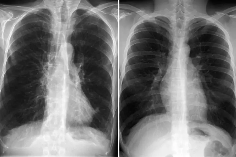Zwei Röntgenaufnahmen des Brustkorbs zeigen Anzeichen von COPD. Ein rosa Puffer könnte zur Linderung der Symptome beitragen.