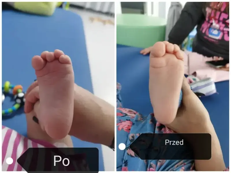 Dwie stopy dziecka, jedna po drugiej. Widać postęp w leczeniu szpotawych stóp.