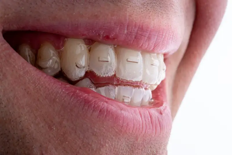 Uśmiech z niewidocznymi nakładkami Invisalign Comprehensive, które delikatnie korygują zgryz.