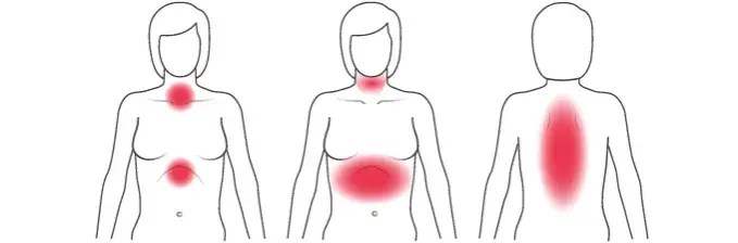 Herzinfarkt Frauen Symptome: Unterschätzte Anzeichen rechtzeitig erkennen