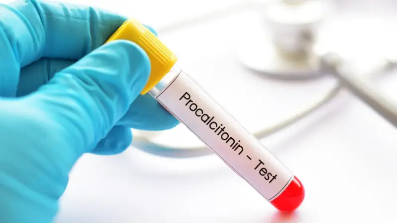 Ręka w niebieskiej rękawiczce trzyma probówkę z napisem "Procalcitonin - Test". To ważny pct.