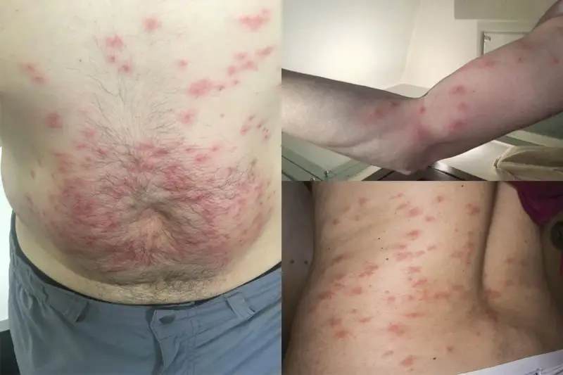 Punture di acaro su addome, braccio e schiena. Lesioni cutanee rosse e pruriginose diffuse.