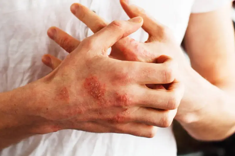 Mani con chiazze rosse e squamose, segno di psoriasi. Nonostante non sia mortale, la psoriasi può avere un impatto devastante sulla qualità della vita.
