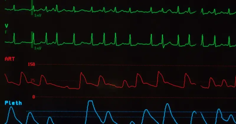 Monitor EKG pokazuje nieregularne fale, sugerujące migotanie przedsionków. Widoczne są również linie ciśnienia krwi i pulsoksymetrii.